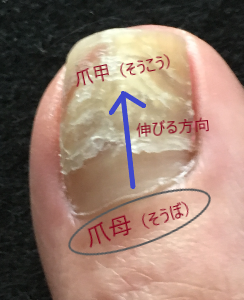親指 母趾 の爪が剥がれた 訪問看護 フットケア Blue Green 横浜 川崎